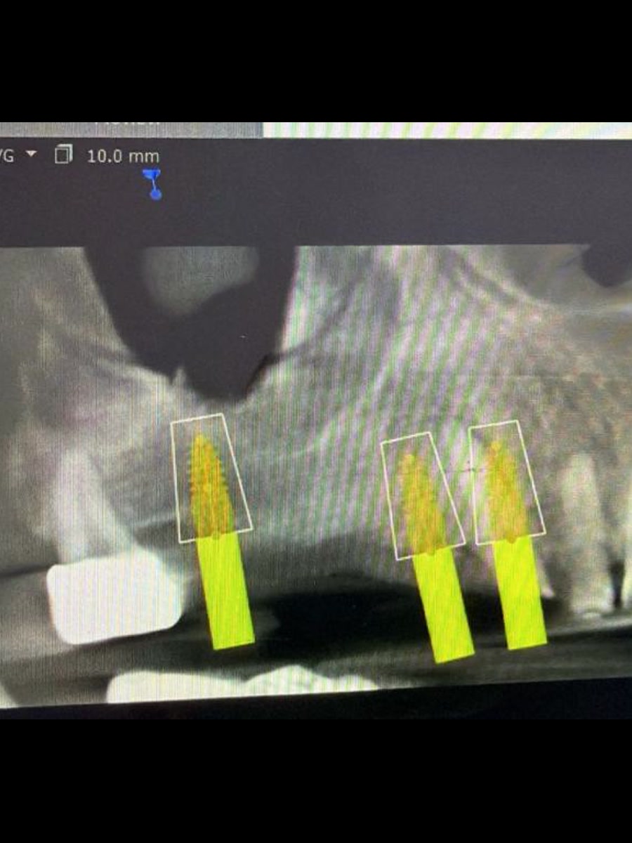 Implantes Dentales